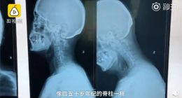 低头族注意：90后IT小伙被诊断出脊柱退化严重