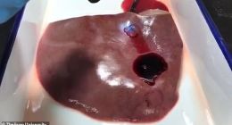 神奇的仿生胶水：20秒内迅速止住大出血且无需缝合