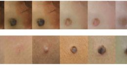 Google发布机器学习在皮肤病检测方面的两项新研究