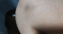 哈啰单车故障说来就来！骑车10秒钟，回家躺了7天