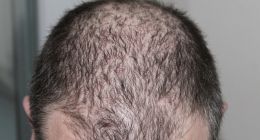 雍禾植发祭出一口价，用户的毛囊安全了吗？