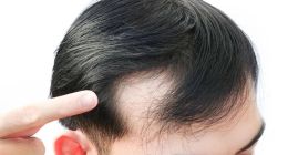 雍禾医疗跌成了“秃头”