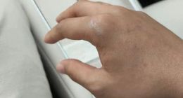 广西南宁一顾客称试驾鸿蒙智行尚界汽车时，手被销售关车门夹伤骨折，涉事门店称其“讹人”